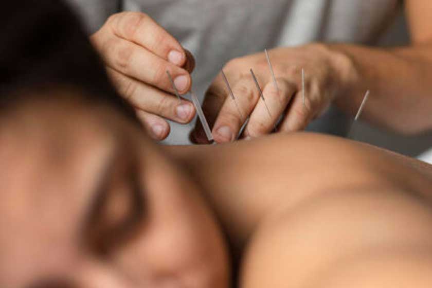 Acupuncture